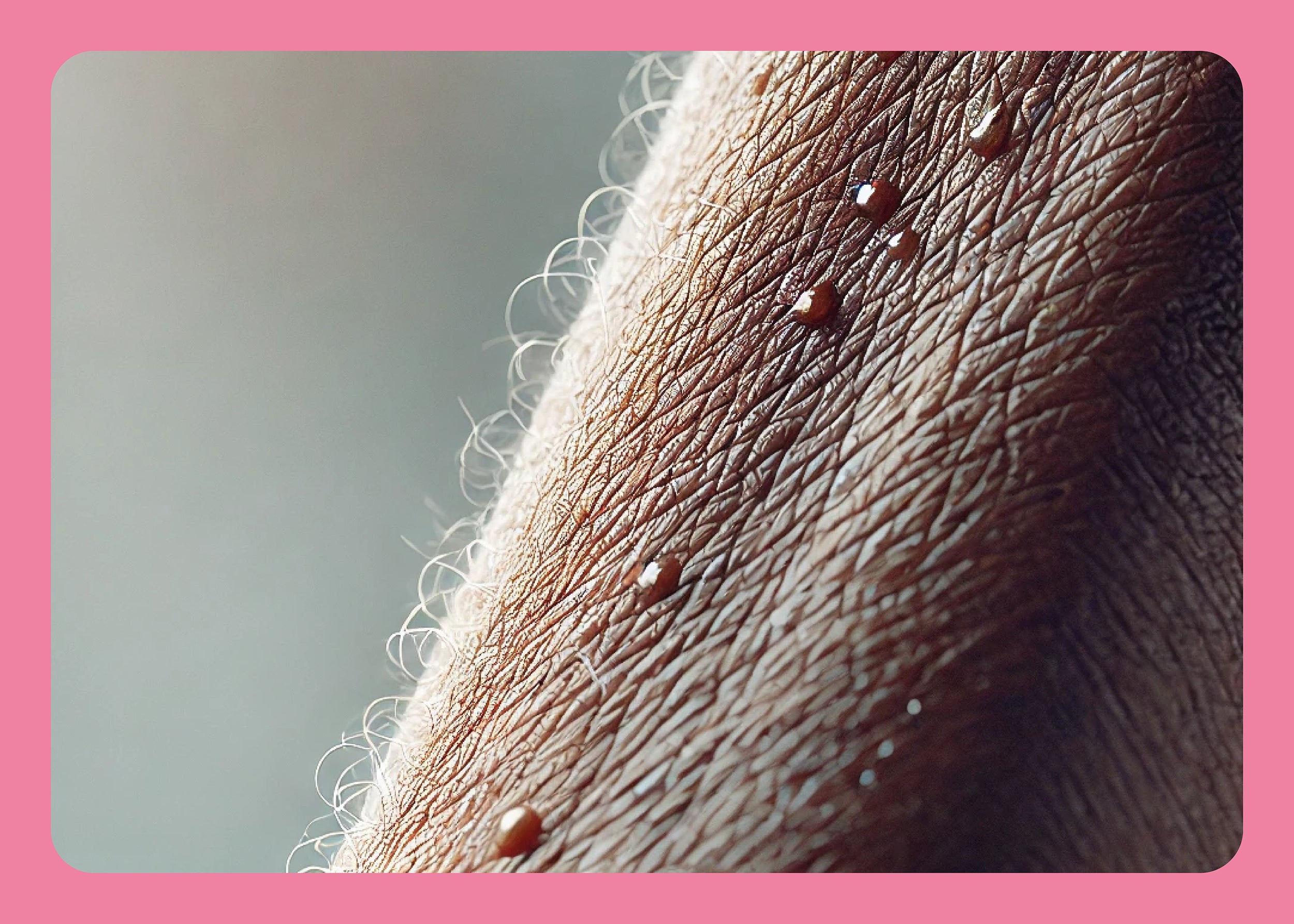 Diabetes… ist auch Hautsache