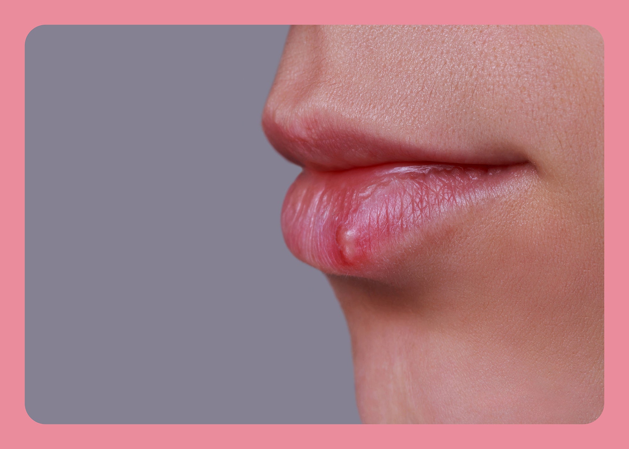 Herpes auch im Mund – da hört der Spaß auf!