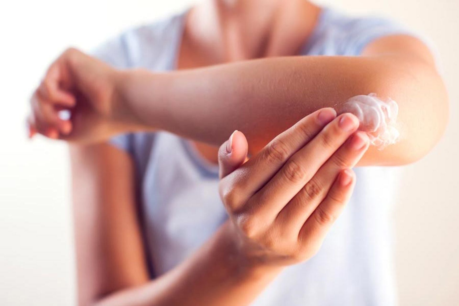 Frau mit Schuppenflechte reibt sich den Ellenbogen ein