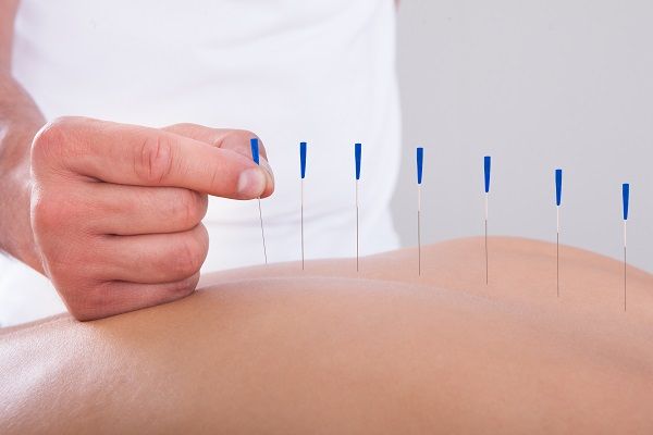 Akupunkturnadeln bei Nervenschmerzen