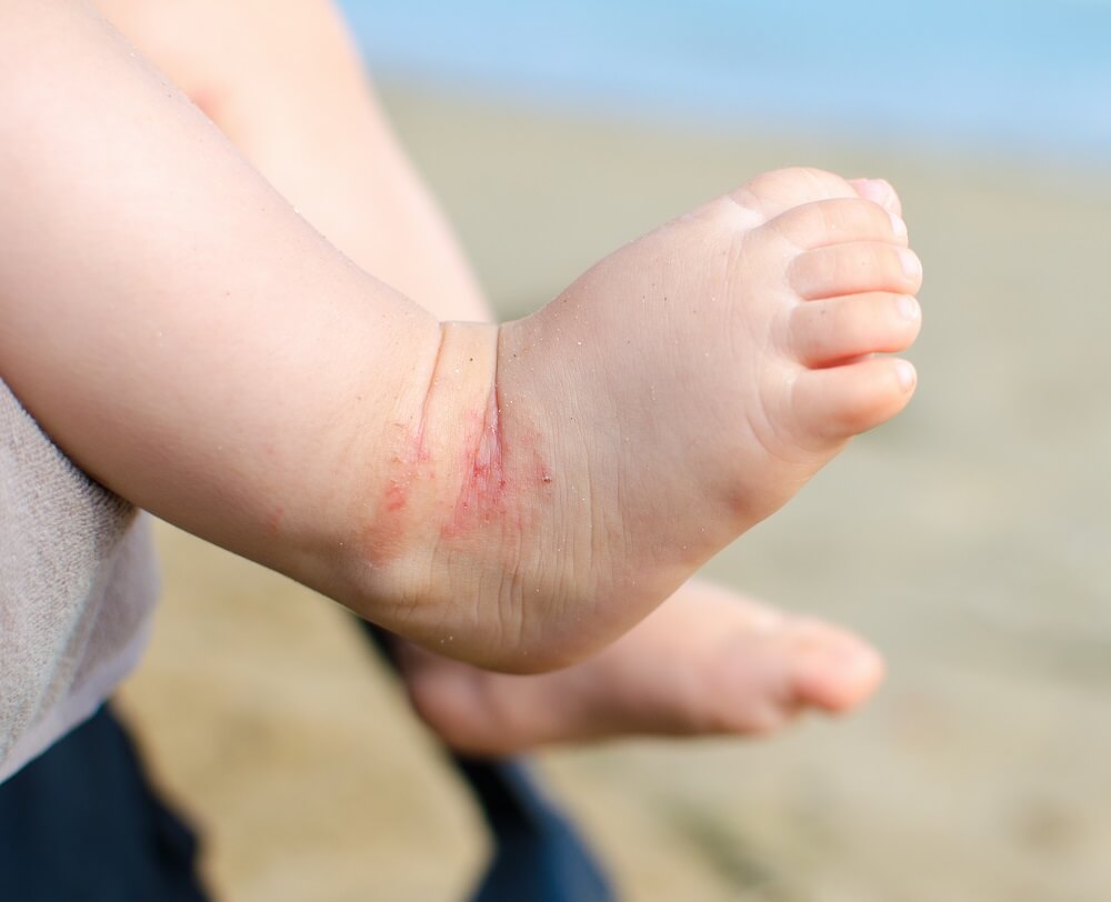Neurodermitis-Stelle am Fuß eines Kleinkindes