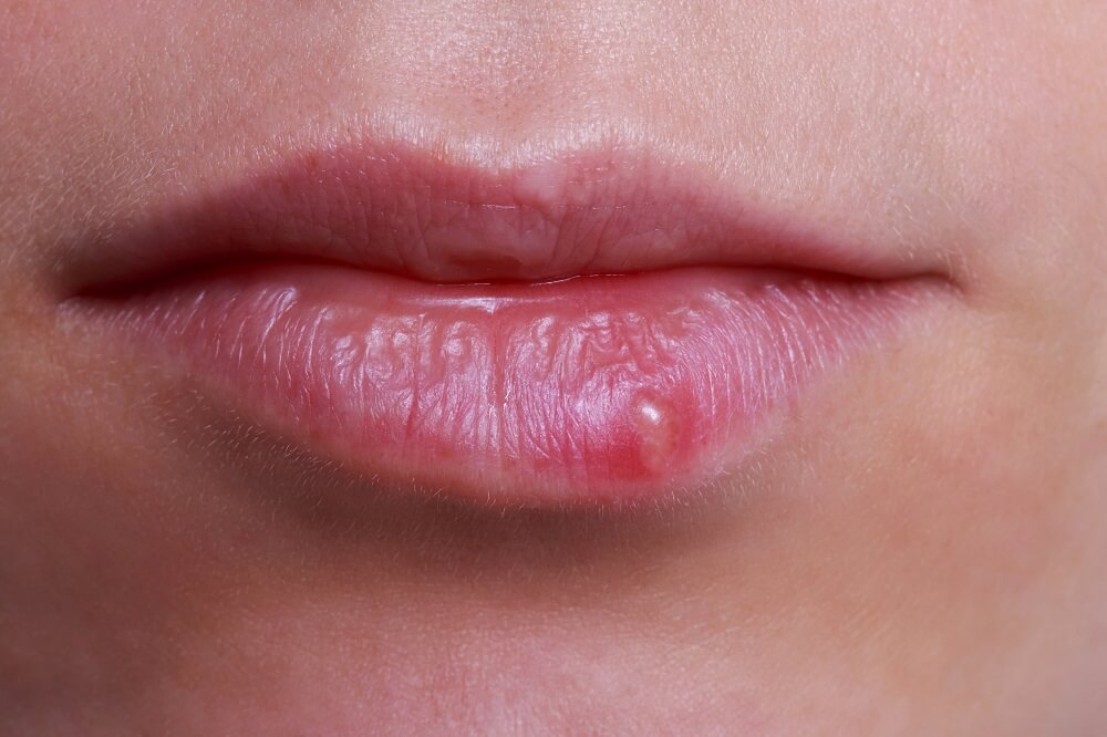 Lippe mit Herpesbläschen
