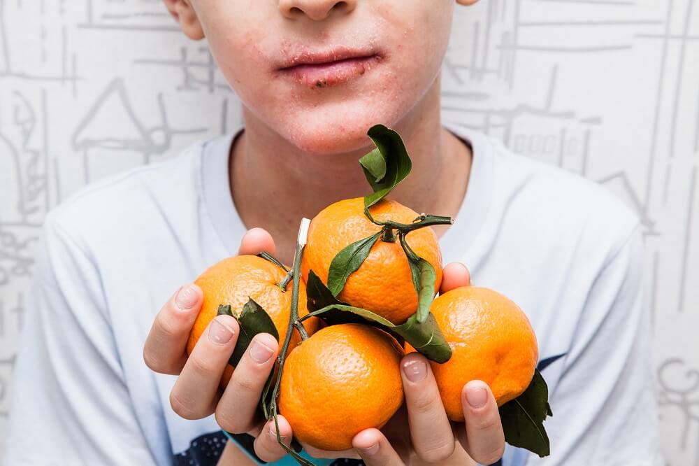 Junge mit Neurodermitis im Gesicht hält vier Orangen in den Händen