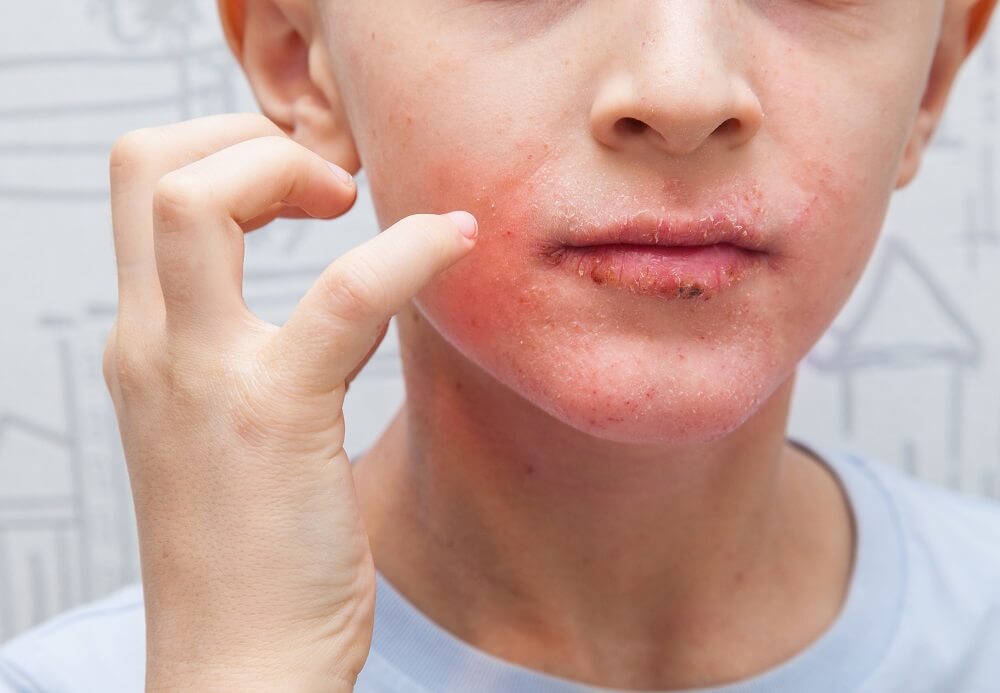 Junge mit Neurodermitis im Gesicht greift sich an die Wange